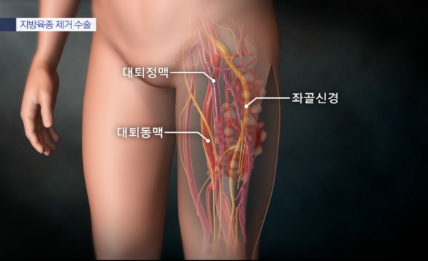 자궁지방혈관육종 암정보공유